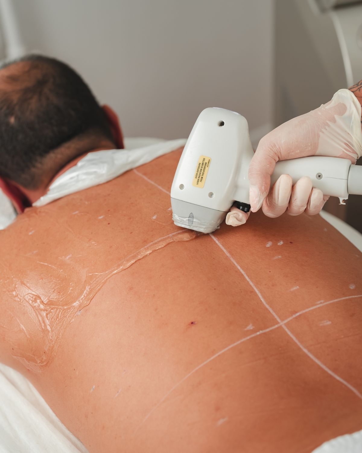 Depilação a Laser