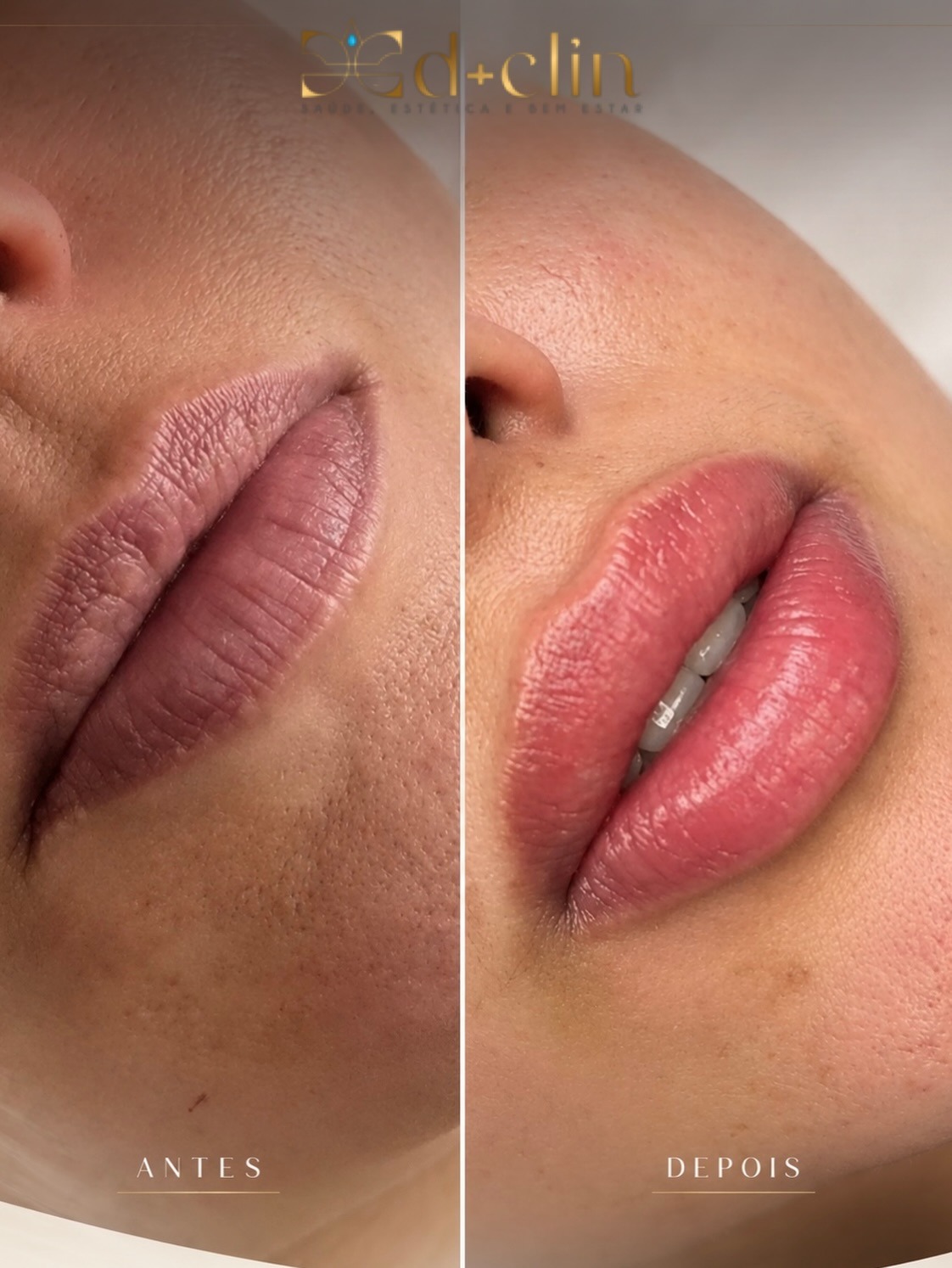 Ocean Lips — resultado real D+CLIN (antes e depois)