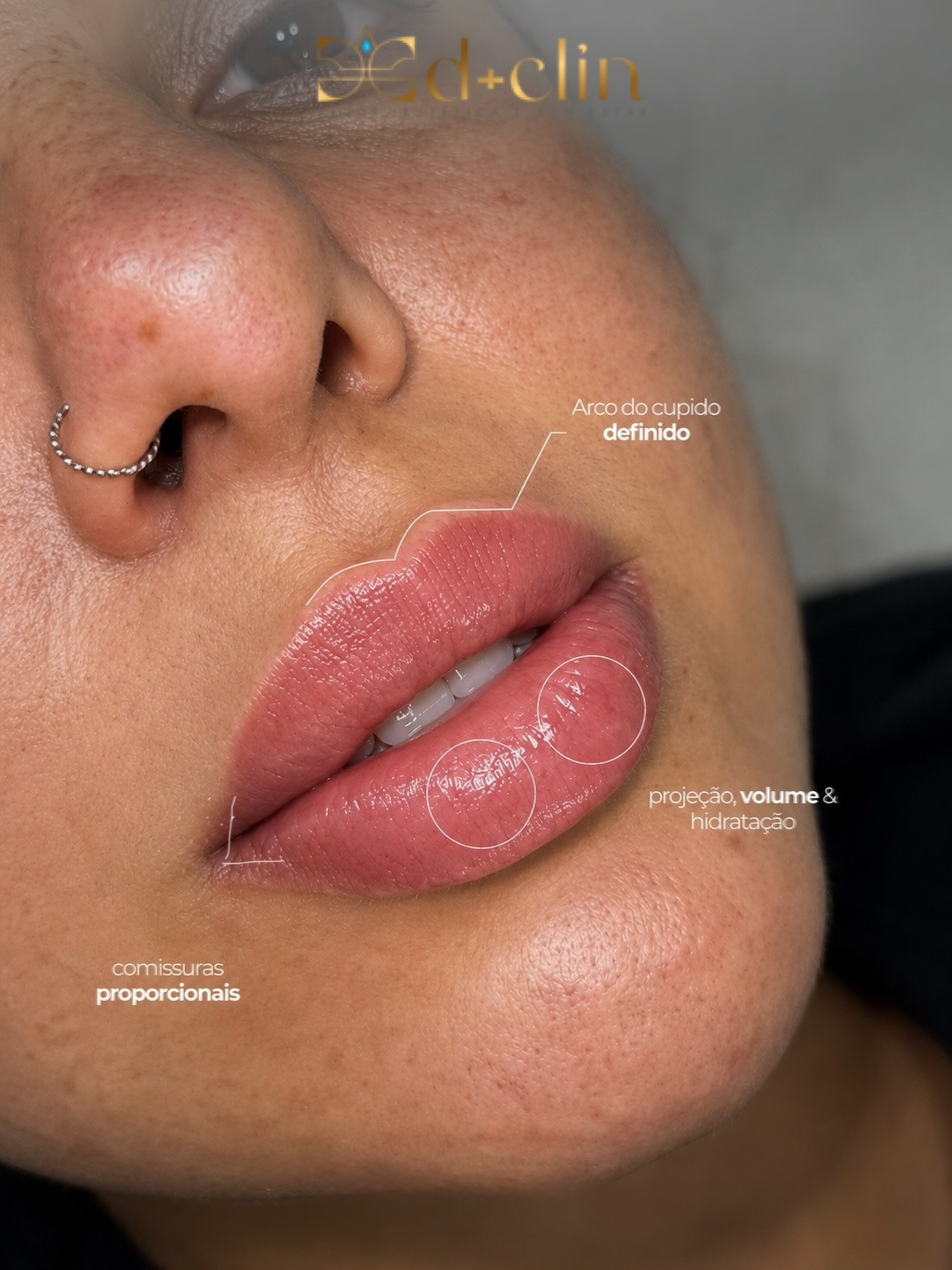 Ocean Lips D+CLIN — arco do cupido definido, projeção, volume e comissuras proporcionais
